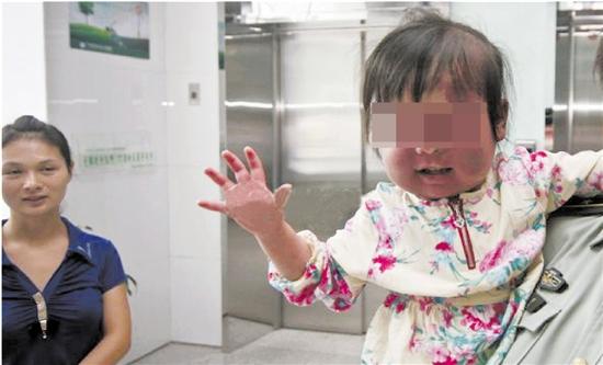 金华1初中女孩面部因病变形辍学 或因妈妈孕期