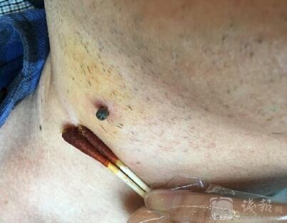 1男子脖子长黑豆以为患皮肤癌 经查系被蜱虫叮