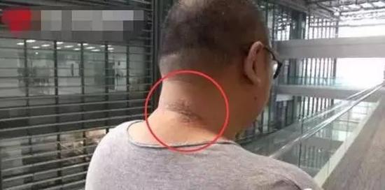 嘉兴男子拍死一只虫子致皮肤溃烂 半个脖子都是肿的(组图)
