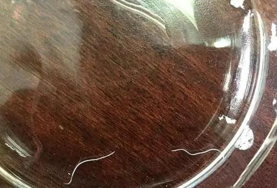 绍兴62岁大伯眼睛里爬出活虫子 或来自家里的