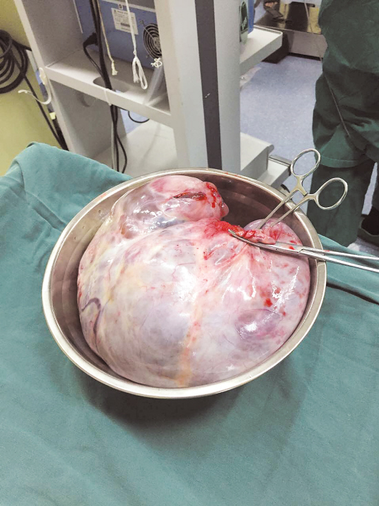 台州八旬老太腹部隆起好似怀孕8个月 原是肚里