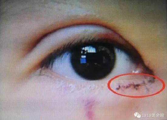 嘉兴1女子做眼部手术后留疤 称医生做了个假动