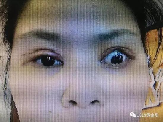 杭州一姑娘做到双眼皮手术 术后眼睛大得可怕