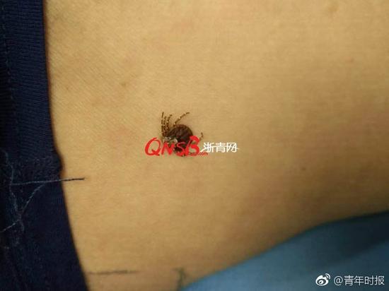 今年第一波蜱虫来了!杭州大伯大腿根部不幸中招