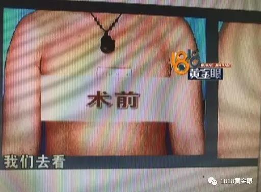 宁波一女子隆胸觉得胸下垂 责难医院没整好