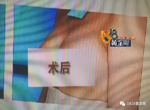 宁波一女子隆胸觉得胸下垂 责难医院没整好