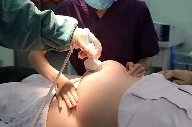 杭州一位医生在大肚皮上摸了摸 剖宫产立马变顺产