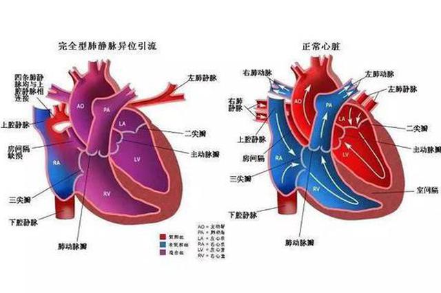 浙江26岁女孩嘴是蓝色的 25年的疾病背后很心酸