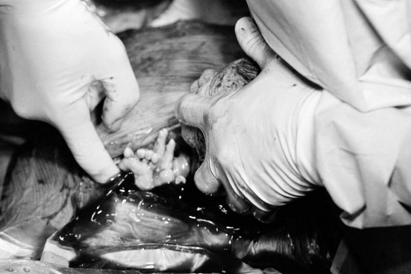 非常纪实,婴儿从母体取出的全过程