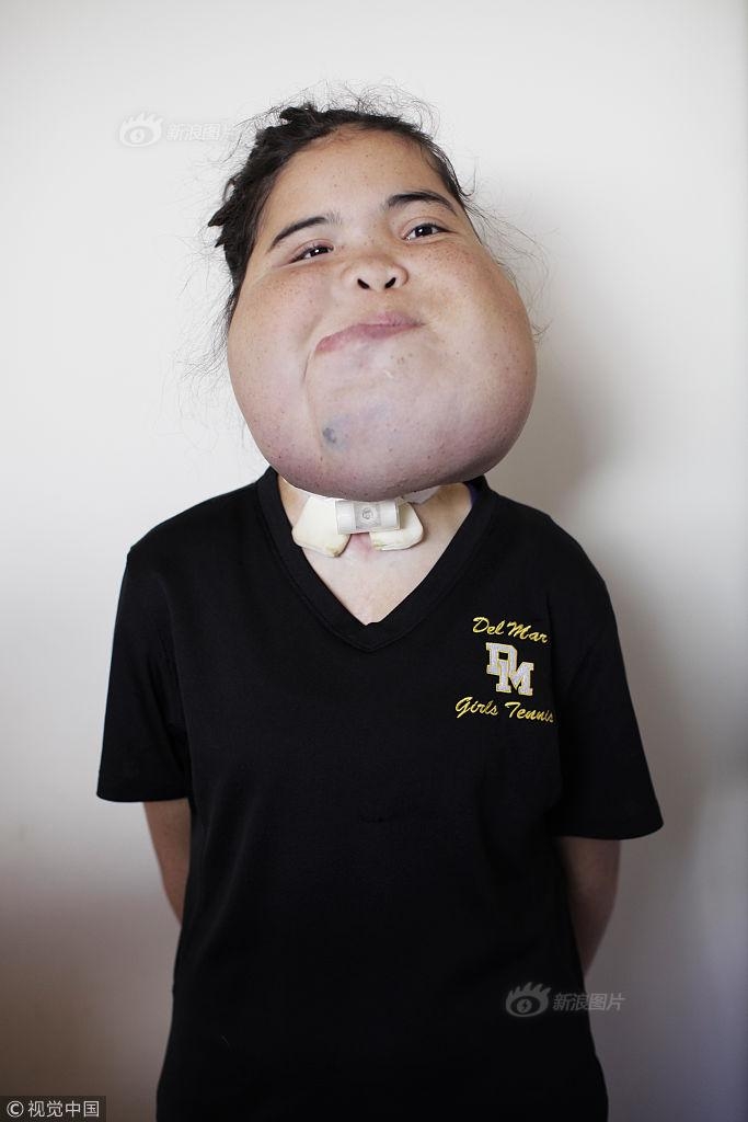 美国少女患疾面部肿大