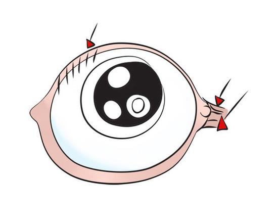  虽说，眼屎多并不意味着细菌感染，