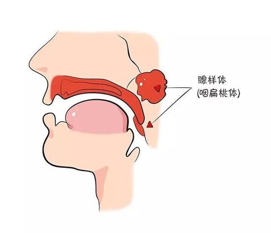 扁桃体和它的小伙伴都失守了要割吗