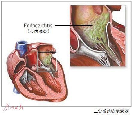 二尖瓣感染示意图