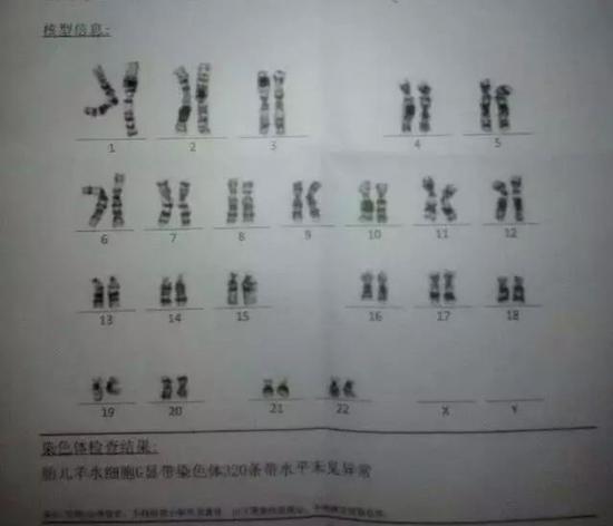 怀孕50天超声看孕囊能看出男女