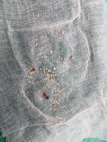 术后在小钟体内取出的右肾结石.通讯员供图