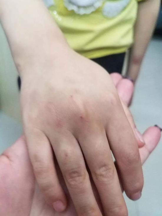 七岁女童疑遭母亲家暴下体撕裂伤程度高达四度