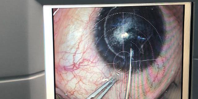 翟长斌：近视眼的预防和治疗全攻略以及近视眼手术矫正方法