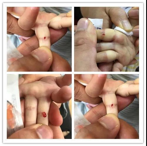 孩子得了疳积针挑四缝最管用