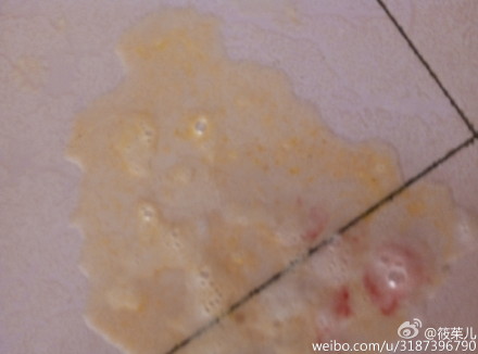 孩子咳嗽呕吐物带血怎么办 手机新浪网