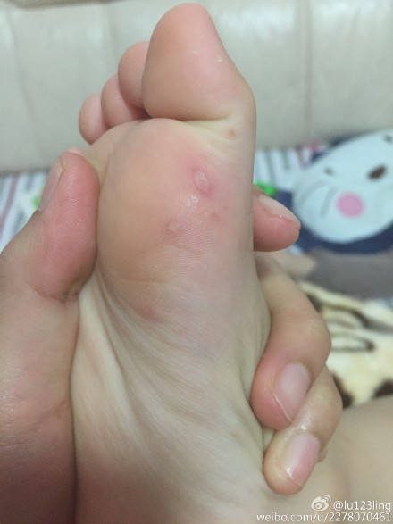 宝宝双脚底有水泡是手足口?(图)|手足口|疱疹|张思莱_新浪育儿_新浪网