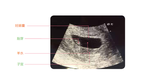 初期怀孕b超单子图片图片