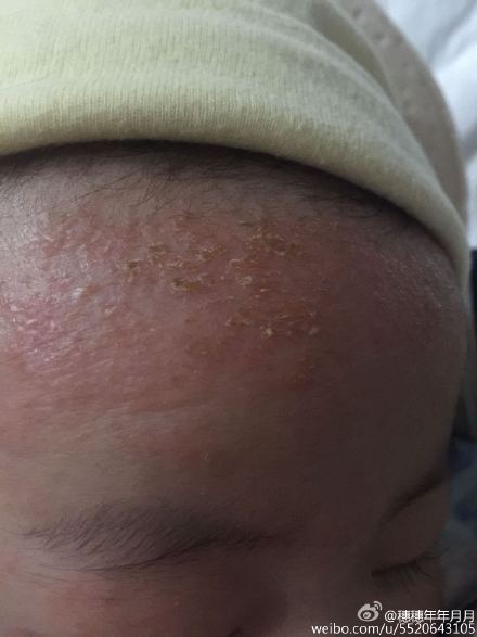 婴儿湿疹厚厚的黄结痂图片