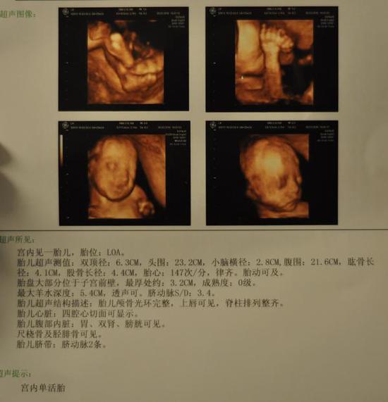 宫内孕b超图片