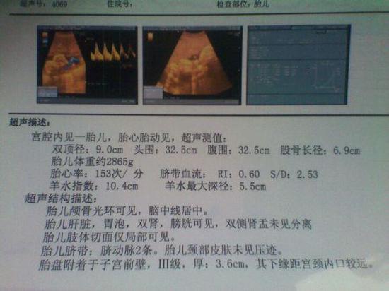 怀孕2个月b超单图片