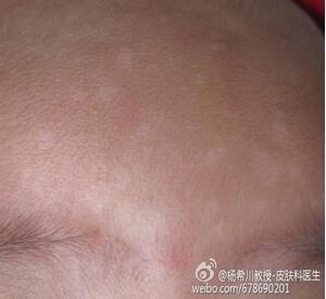 皮科专家解惑贫血痣是贫血引起