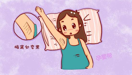由于雌激素的增加,大部分孕妈妈会出现乳头乳晕颜色变深发黑,乳房处