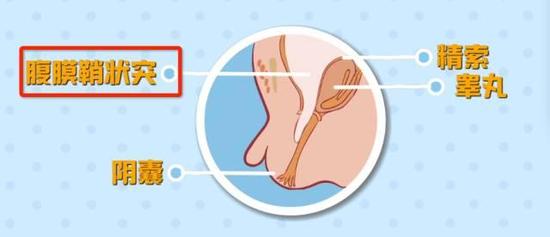 疝气|宝宝|腹股沟_新浪育儿_新浪网
