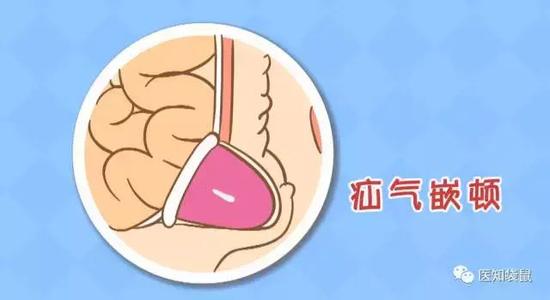 鞘膜积液|疝气|宝宝_新浪育儿_新浪网