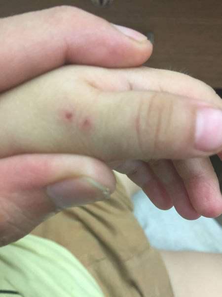 幼儿园一名幼儿被老鼠咬伤合肥已成立调查组