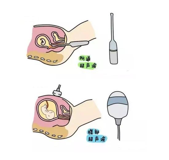 阴式超声是通过超声机上的特殊探头而实现的,在阴道超声探头上套上