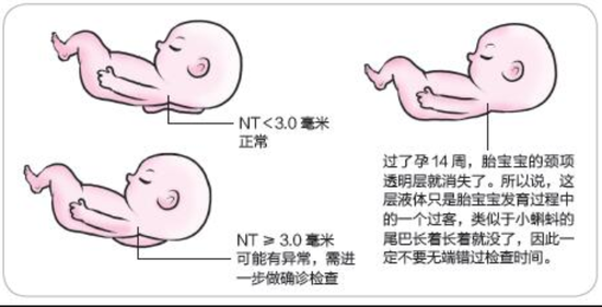 nt筛查首次排畸检查