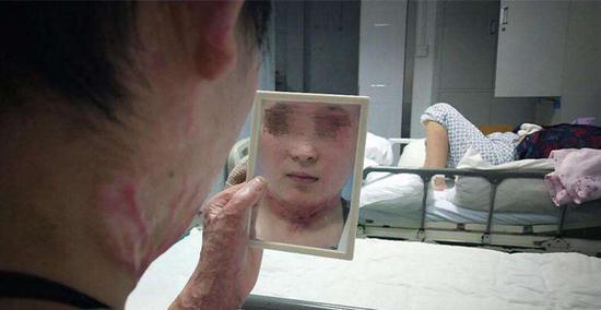 16岁女孩保护弟弟火场逃生自己却被严重烧伤毁容