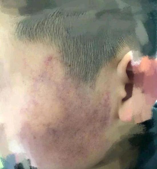 被打学生.图片来源于网络