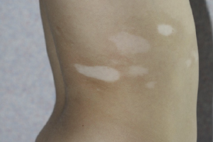 白癜风夏季多发 青少年患者综合治疗正当时