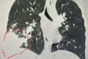 娃肺都白了家长还不愿住院 是谁让孩子“病不起”？