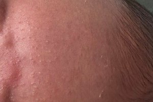  How should the seborrheic dermatitis on the baby's head be nursed?