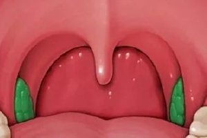  How should child tonsil agnail do?