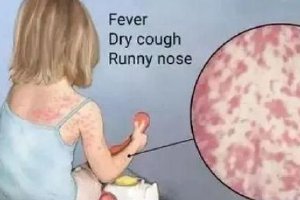 猩红热进入发病高峰期 儿童出现发热、皮疹等应及时就医