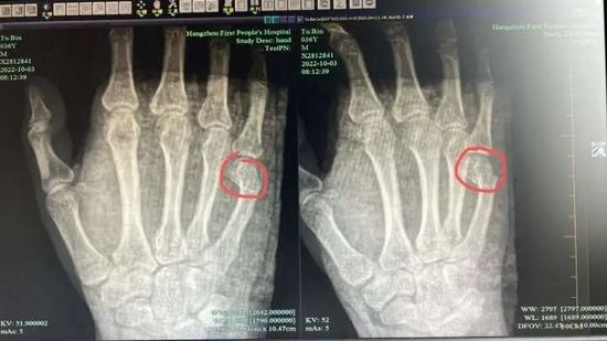 一道题讲了半小时 爸爸辅导作业一拳把自己手锤骨折 辅导 作业 孩子 新浪育儿 新浪网