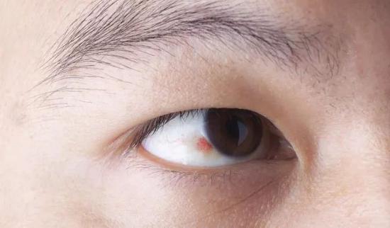 眼睛有红血丝是没休息好有这7个症状快去看医生