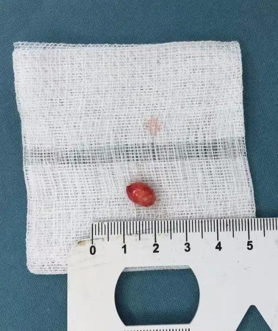 表皮样囊肿是怎么回事如何治疗