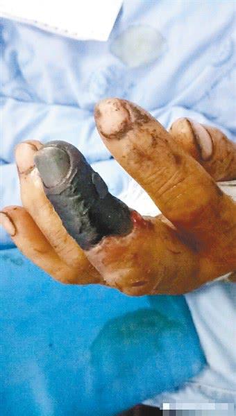 男子遭五步蛇咬险丧命 已花费七万还要截肢