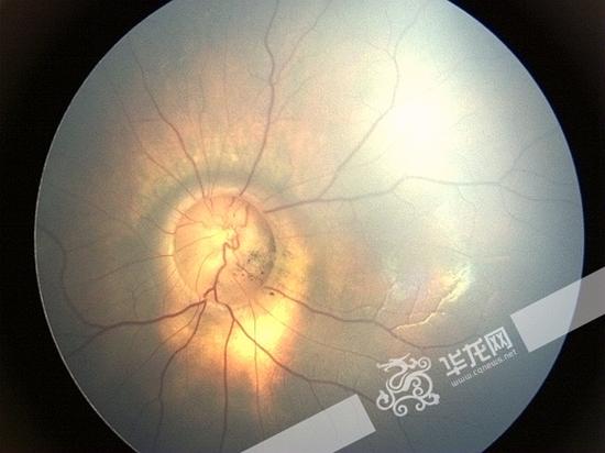 新生儿眼睛里开出牵牛花一查竟是罕见眼病