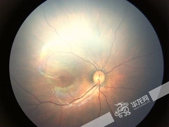 新生儿眼睛里开出"牵牛花" 一查竟是罕见眼病