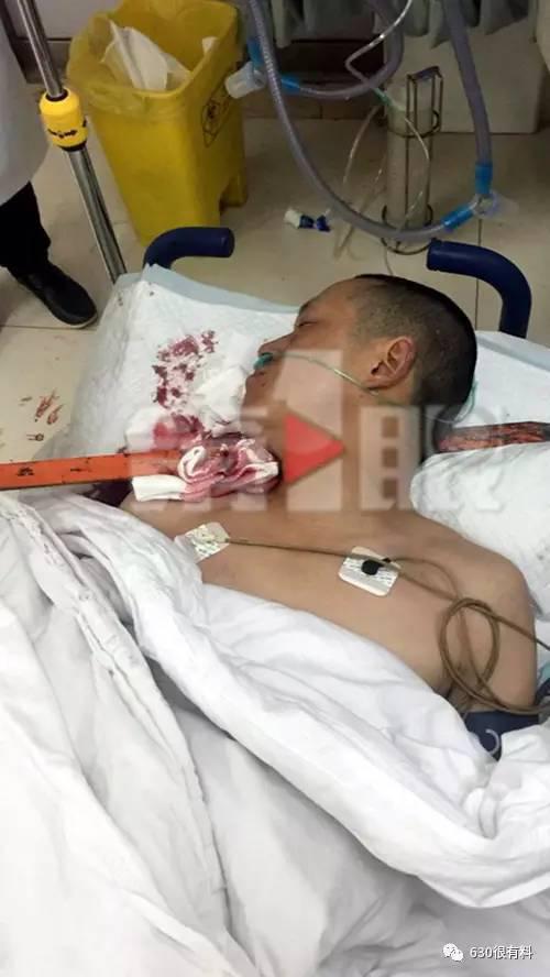 惊魂一幕重庆一男子被3公分钢钎刺穿颈部图