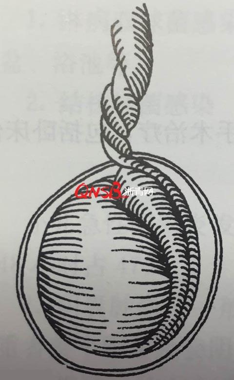 睾丸扭转(鞘外扭转),好发于新生儿期